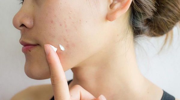 Artefacto En la madrugada Riego Cómo eliminar las cicatrices del acné con Aloe Vera - Ibizaloe