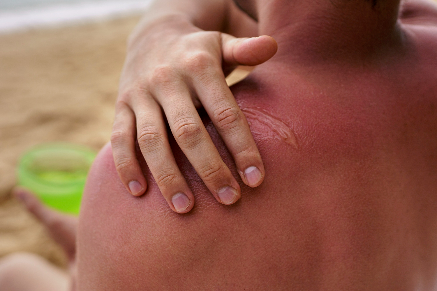 Gel puro de Aloe Vera en quemaduras y heridas